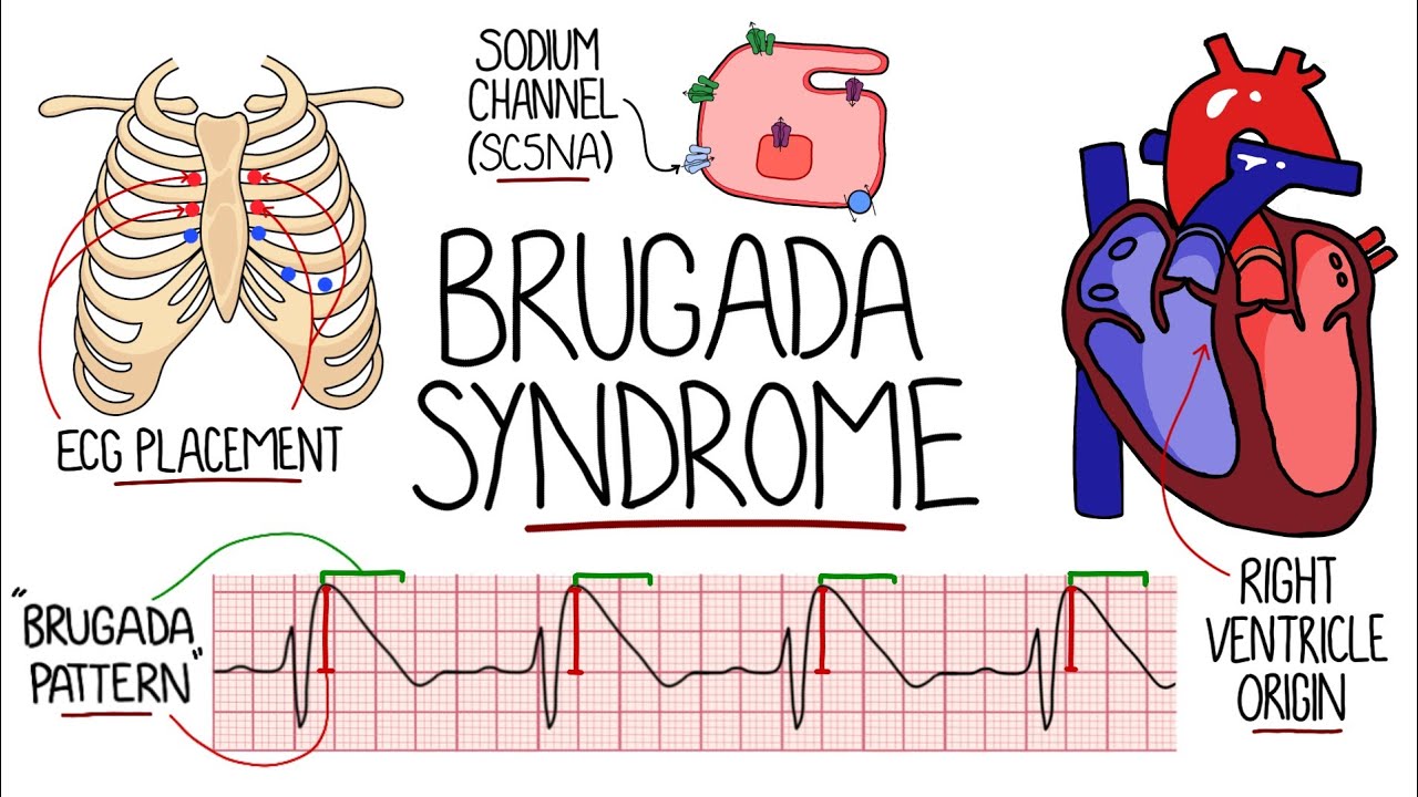 Sindrome di Brugada